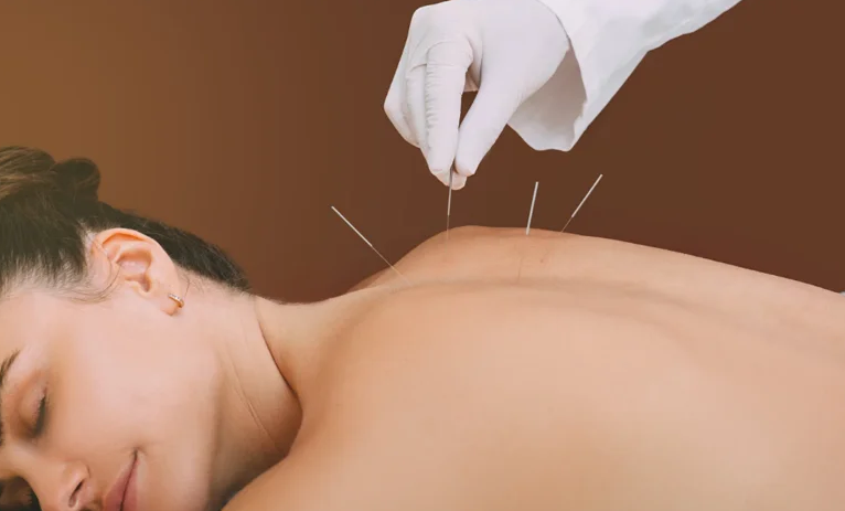 How Acupuncture Can Help Alleviate Headaches and Migraines
